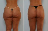 5 x Kavitácia ( 30min )